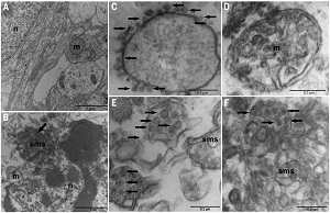 [ZIKV (Zika virus) induces death in human neurospheres. These micrographs show the ultrastructure of mock- and ZIKV-infected neurospheres after 6 days in vitro. (A) Mock-infected neurosphere showing cell processes and organelles. (B) ZIKV-infected neurosphere showing a pyknotic nucleus, swollen mitochondria, smooth membrane structures, and viral envelopes (arrow). (C) Viral envelopes on the cell surface (arrows). (D) Swollen mitochondria. (E) Viral envelopes inside the endoplasmic reticulum (arrows). (F) Viral envelopes close to smooth membrane structures (arrows).]